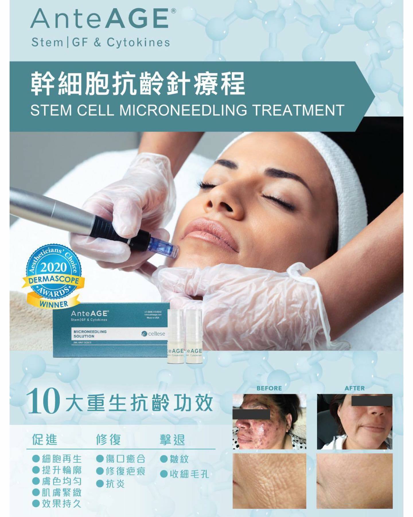 美國AnteAGE幹細胞抗齡針療程