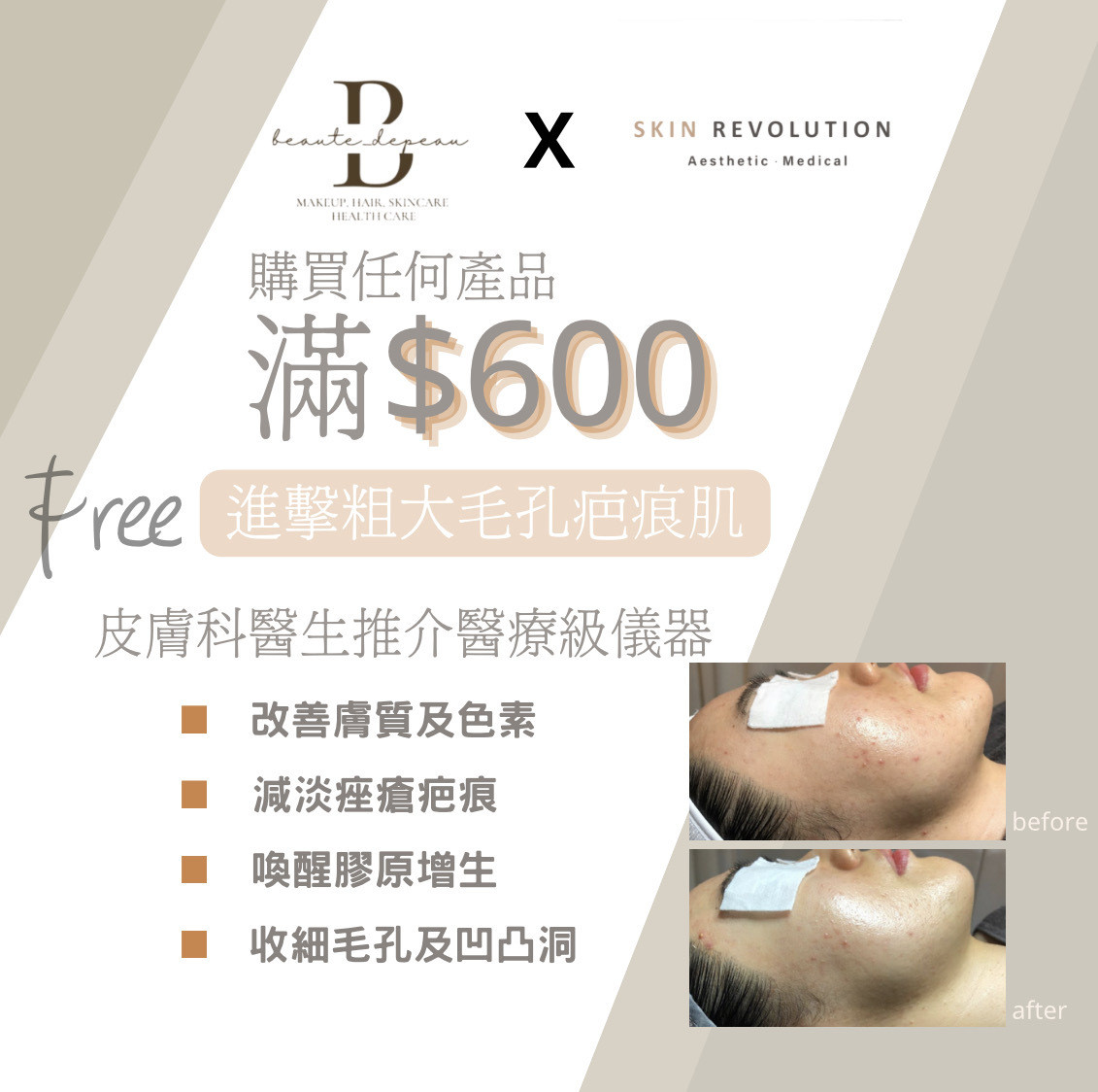 購買任何產品滿$600 送 進擊粗大毛孔痘疤痕肌療程一次