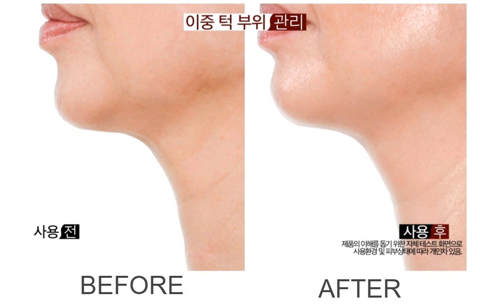 SK164  第二代皮秒激光美白袪斑美容儀