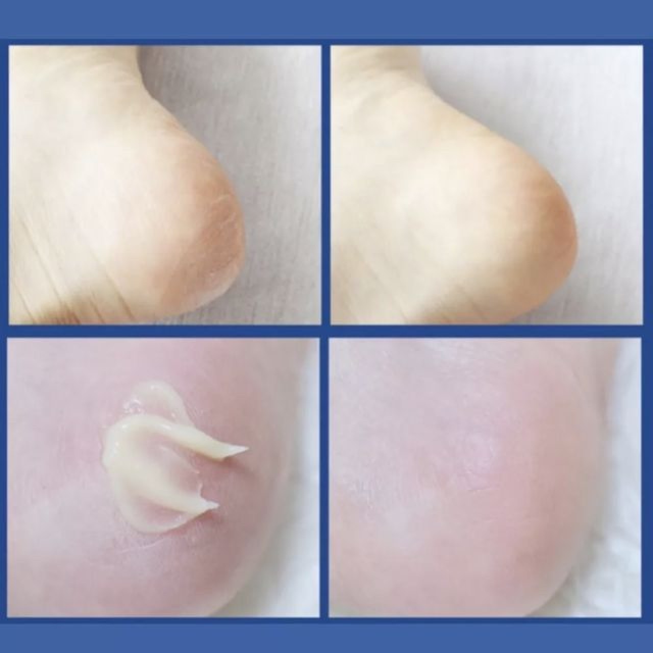 📦預購 MEDI PEEL-EGF去角質修護保濕足霜130g