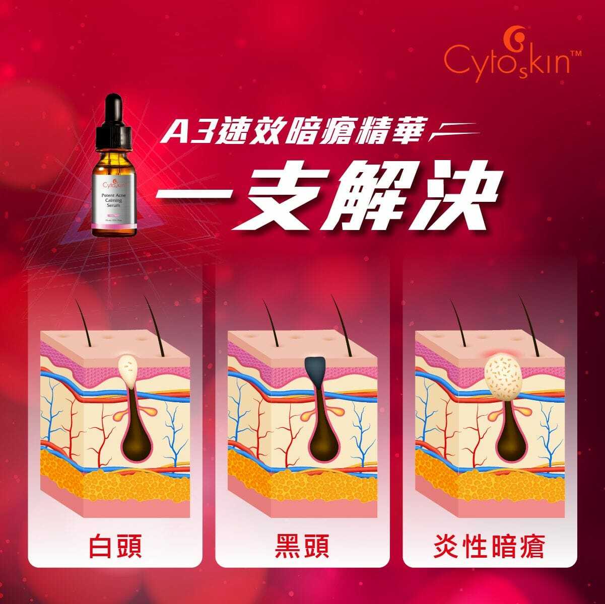 CytoSkin A3速效暗瘡精華 15ml