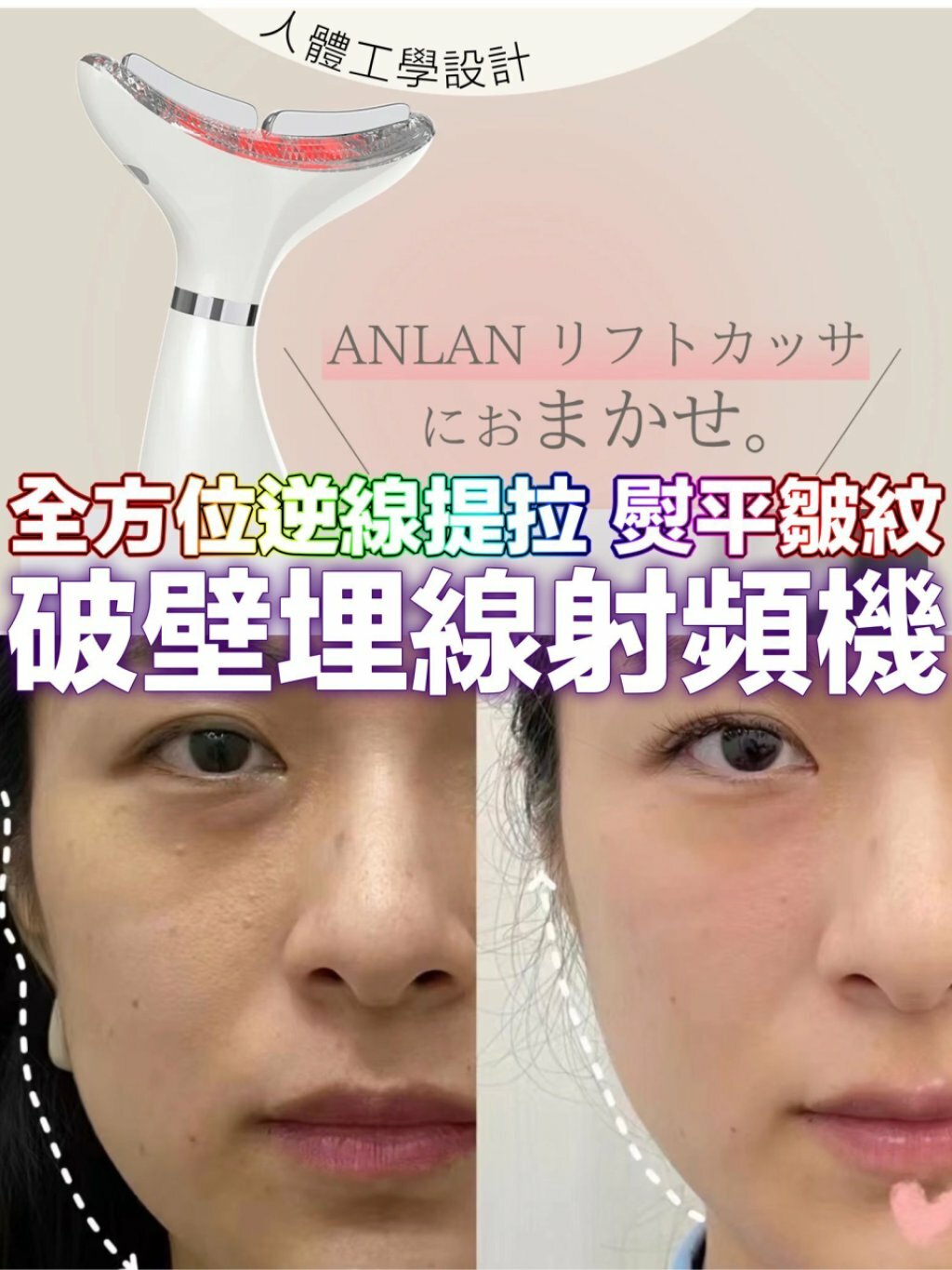 Anlan「熨斗級」破壁深肌埋線射頻機