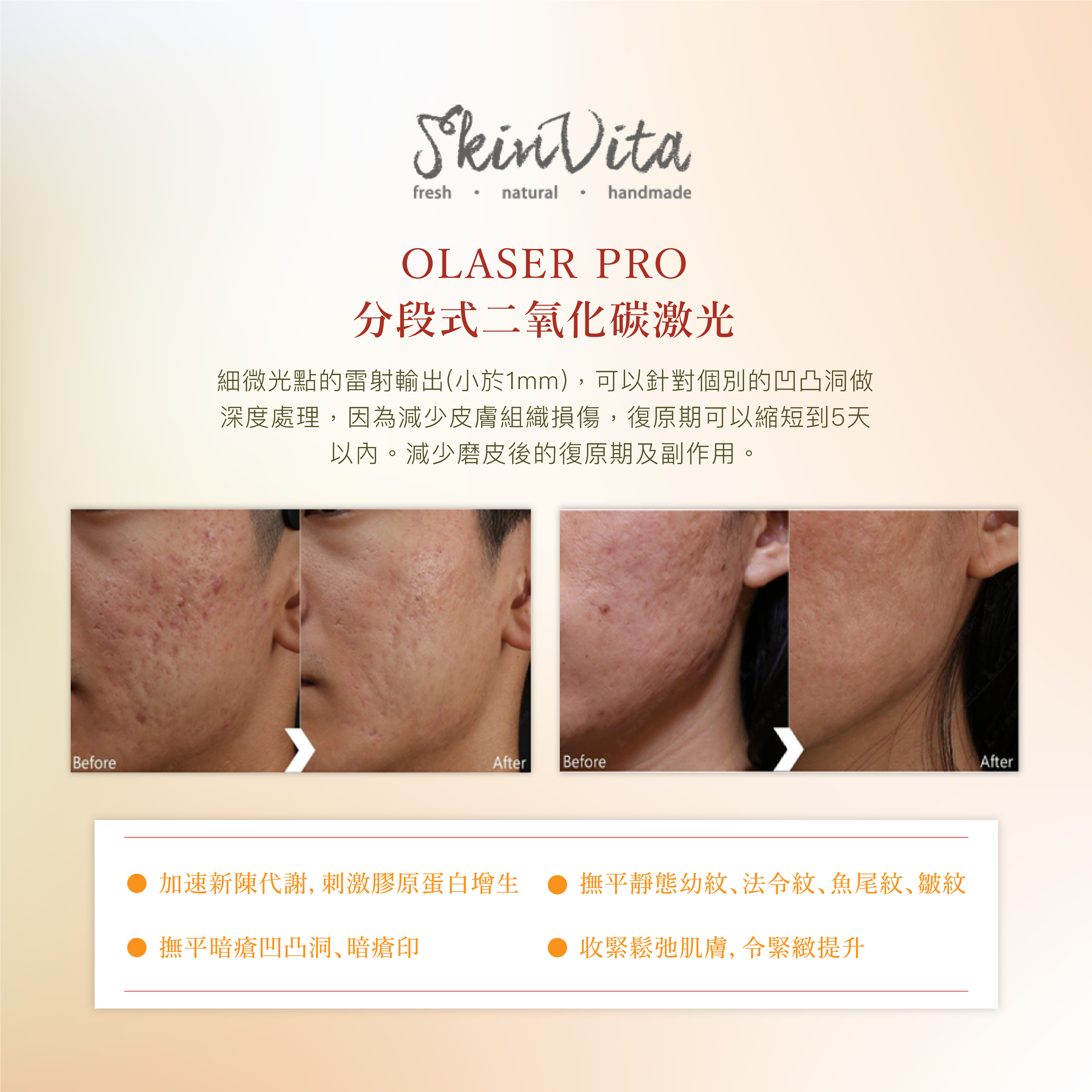 韓國OLASER PRO凹凸洞修復嫩膚療程