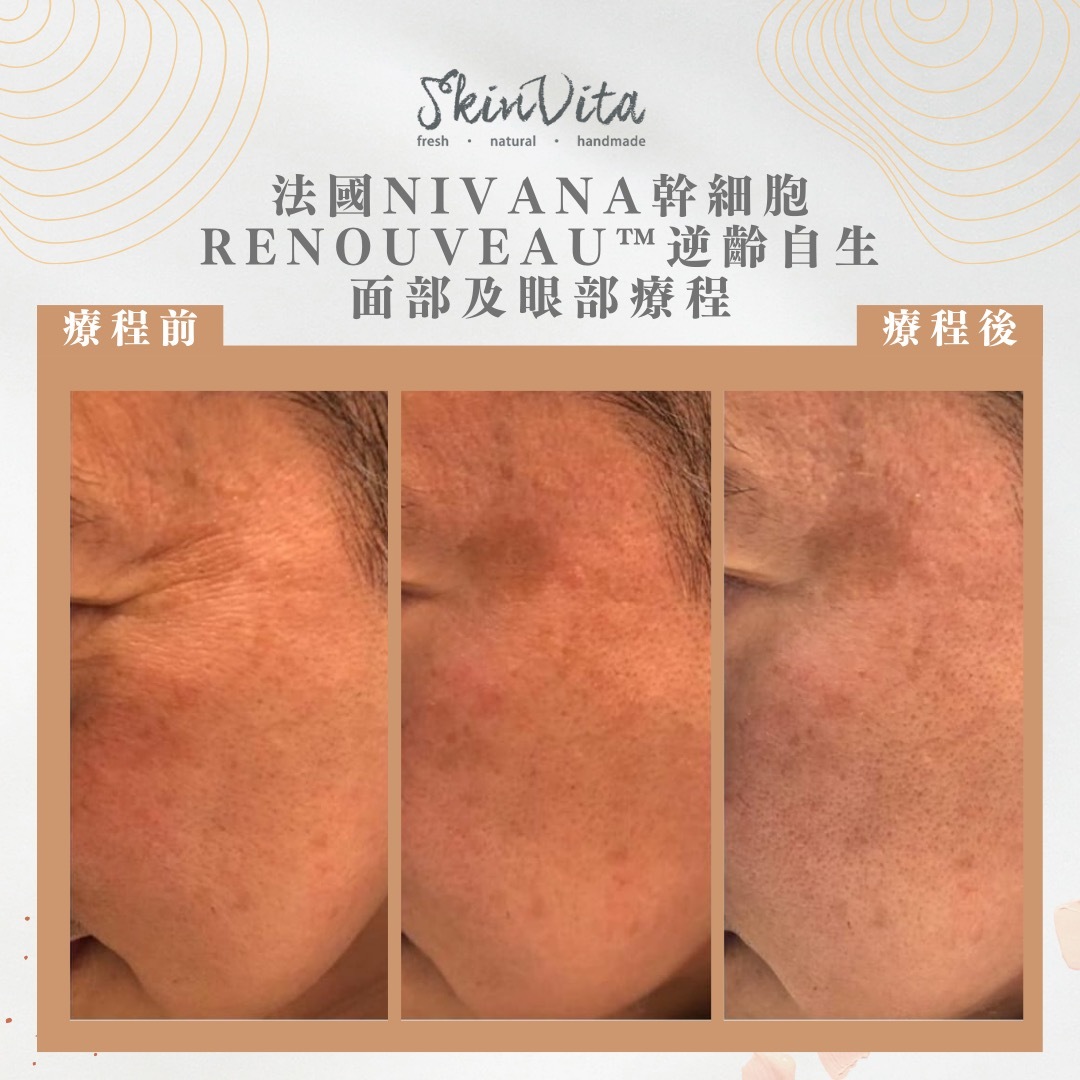 法國Nivana幹細胞Renouveau™逆齡自生眼部療程