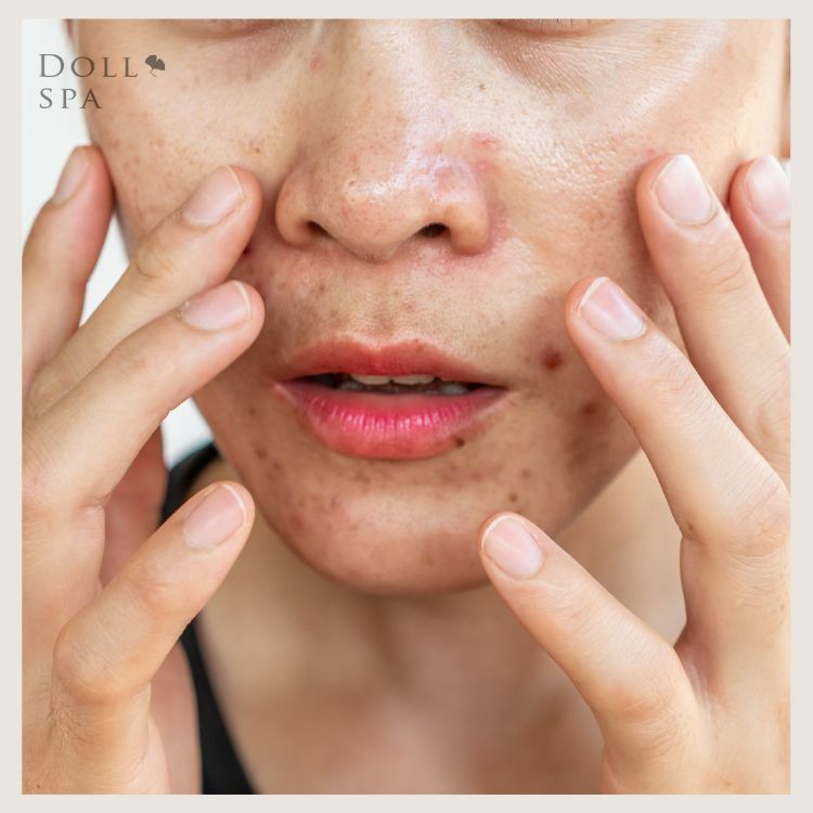 【保養小技巧】你知道臉部大量出油是因為皮膚太乾嗎?