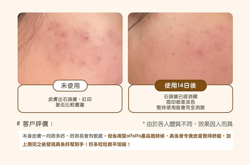 淡印藥酒 ,石頭瘡 ,色斑 ,淡印 , 初苜 ,中醫師配方 ,初苜中醫_5.jpg