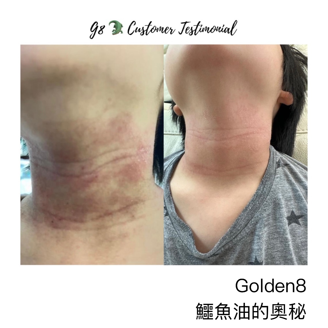 皮膚濕疹 Golden8 Soothing Cream  ｜Golden 8 |  濕疹 ｜傷口救星 | 皮膚炎症 ｜皮膚敏感 ｜牛皮癬｜ 紅疹 ｜皮膚痕癢 ｜痕癢肌 ｜乾燥肌 ｜ 天然成份 ｜中西醫推介 ｜無藥性 ｜不含類固醇
