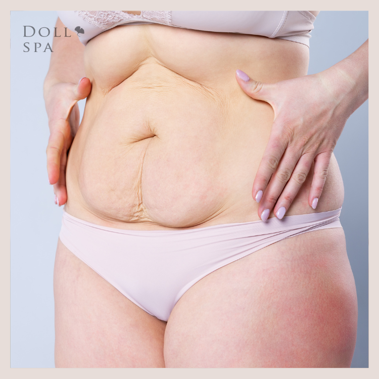 產後黃金恢復期，改善產後肚的4大建議