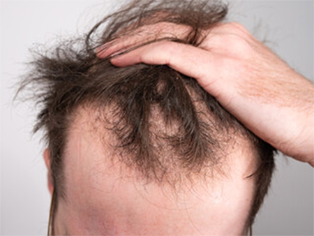 男士脫髮-M字額-男士防脫髮洗頭水