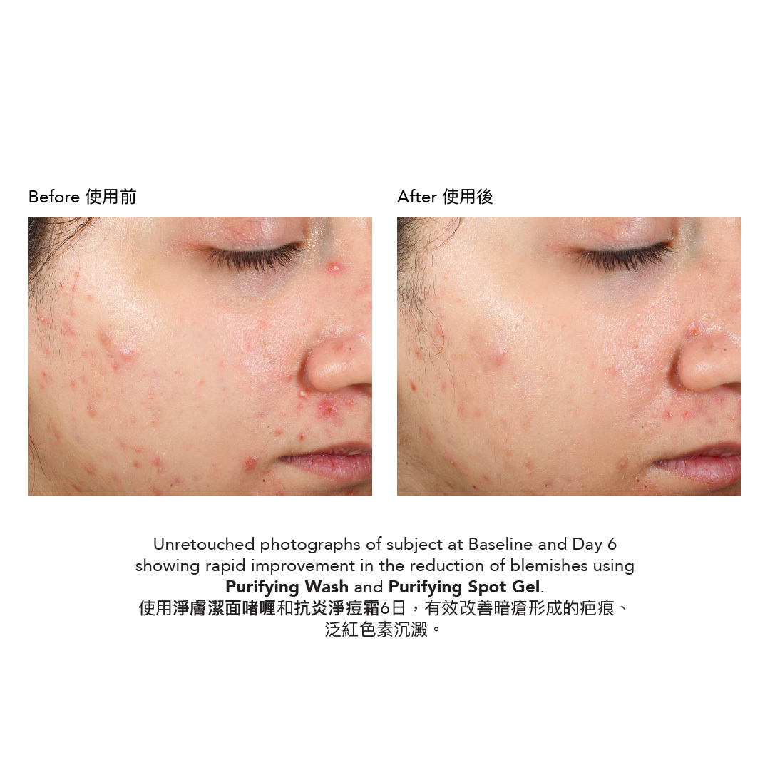 抗炎淨痘霜