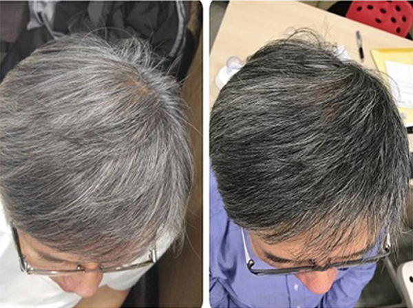 生髮療程優惠-活髮療程-白髮變黑療程