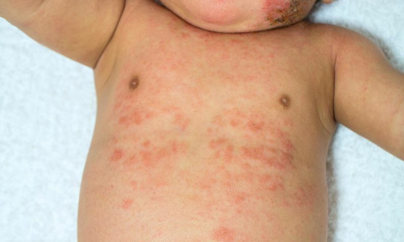 醫師教你異膚寶寶乳液三大挑選原則