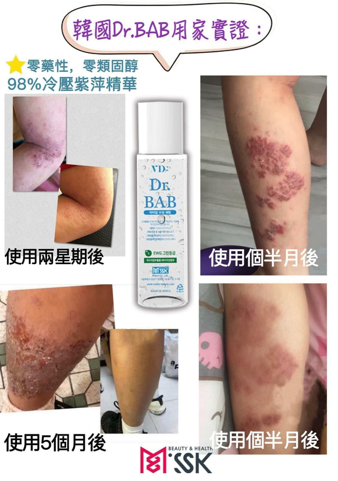 A15 💓DR BAB Soothing Serum 升級+增量限量版💓 🔥濕疹肌🌟敏感肌🌟暗瘡肌🌟牛友癬🌟主婦手救星🔥優惠價$450/1 $799/2(古早皂25%)  $1800(買4送1再送一盒益生元)