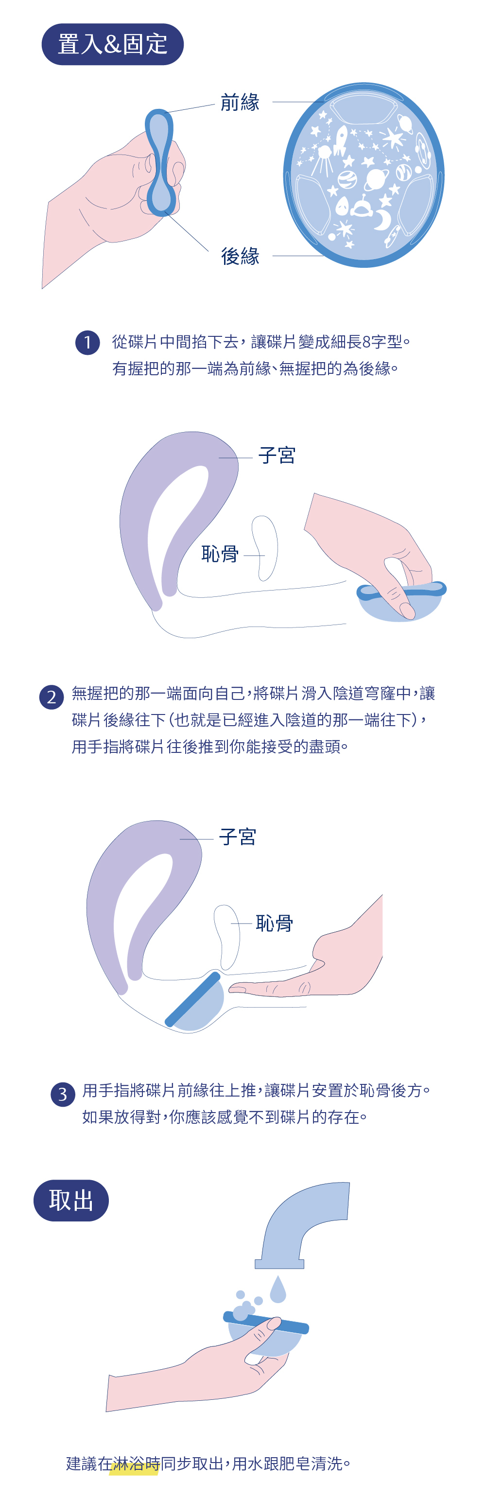 月經碟-月釀碟片-用法