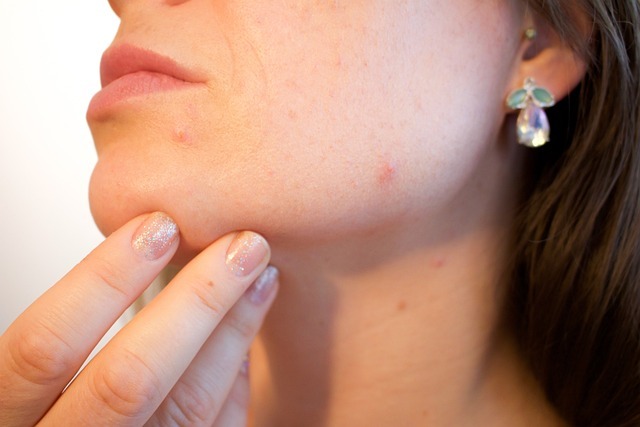缺乏B2可能影響皮膚健康，也較容易長痘痘