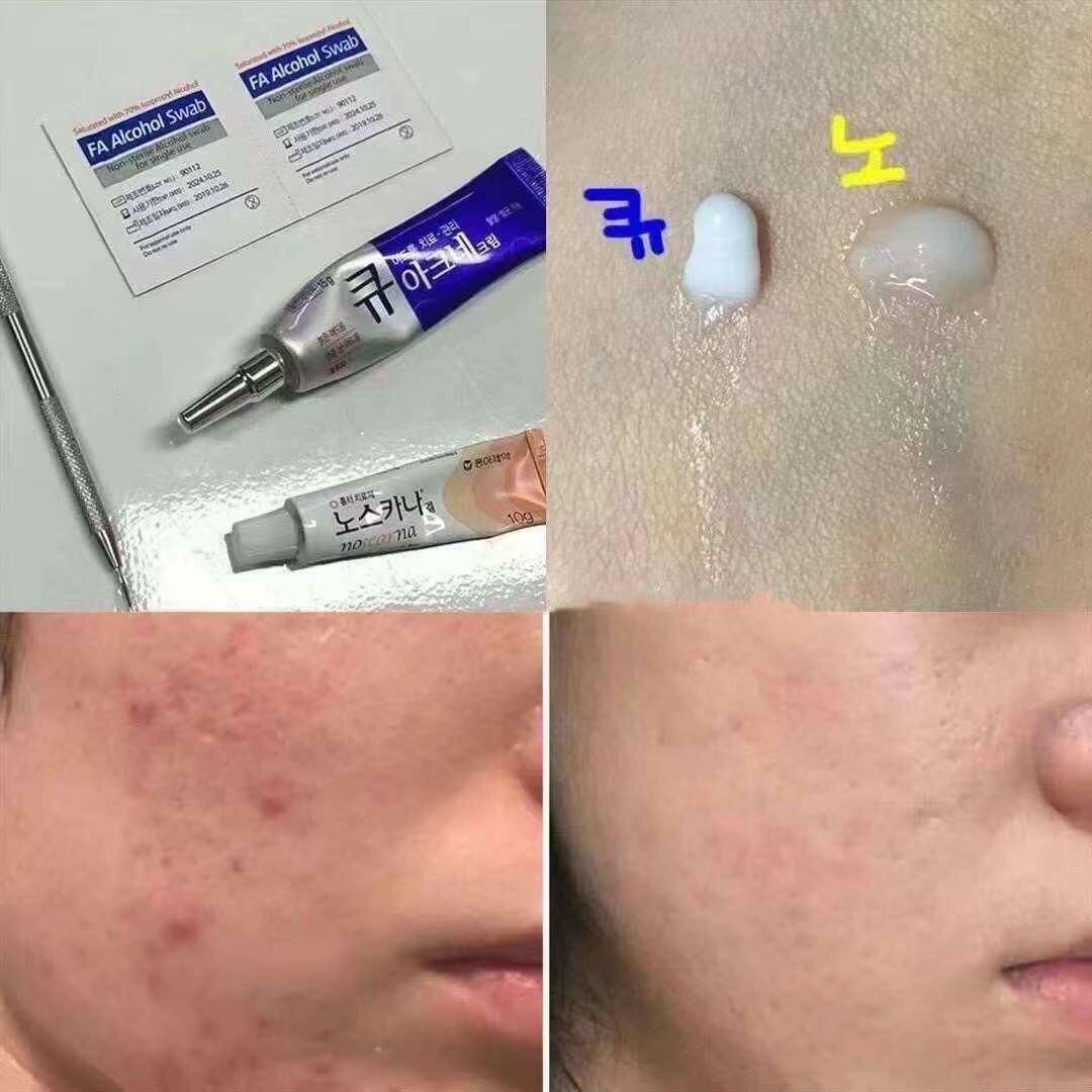 🇰🇷韓國藥房祛痘消炎暗瘡膏15g