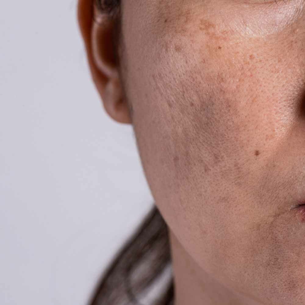 40歲女人臉部皮膚保養問題2-曬斑暗沉出現