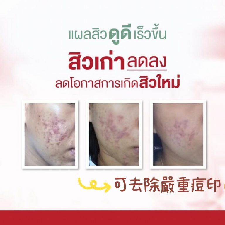 🇹🇭 泰國Puricas龍血樹除疤膏 8g