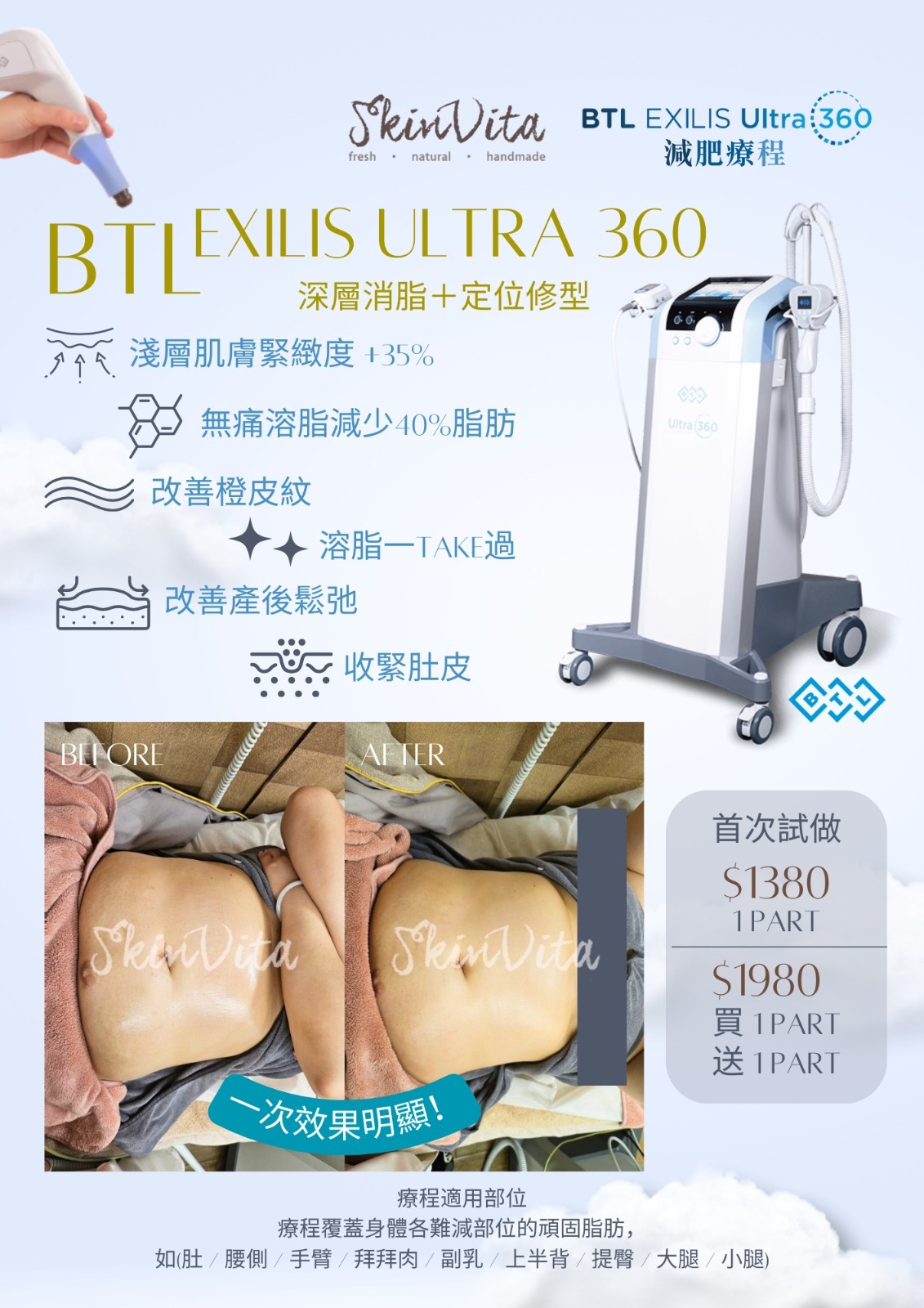 BTL EXILIS Ultra 360 溶脂修身療程