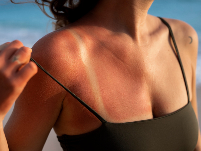 曬老比曬黑更可怕！曬後美白保養的5個小知識