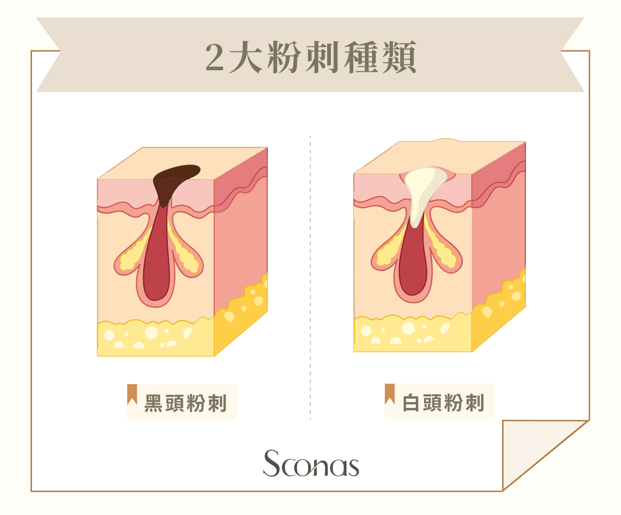 2大粉刺種類