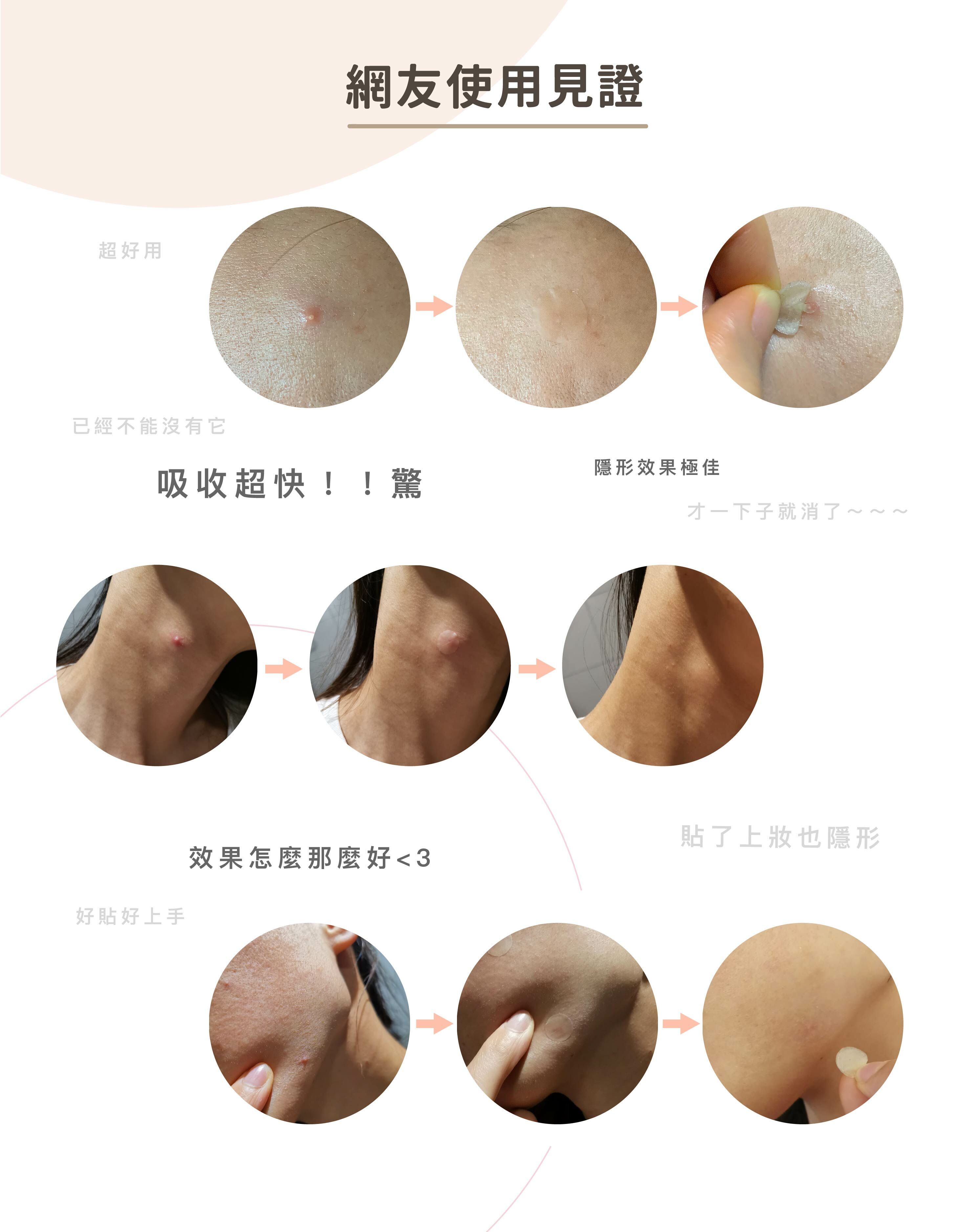 優若美,隱形痘痘貼