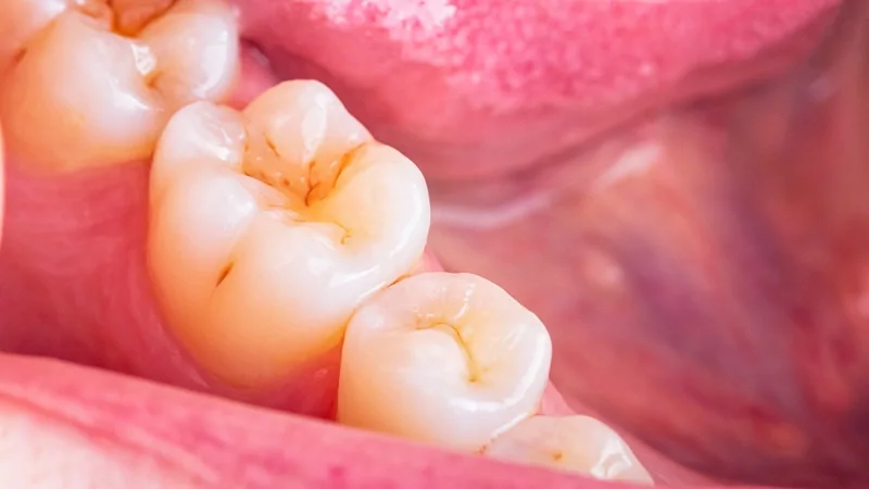 琺瑯質, 牙齒, 口腔, 牙齒健康, 修復牙齒, 受損牙齒, 琺瑯質流失
