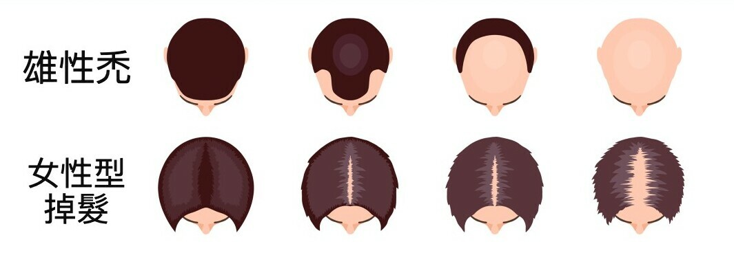 禿頭原因,雄性禿,女性型掉髮,禿頭前兆,禿頭前兆女