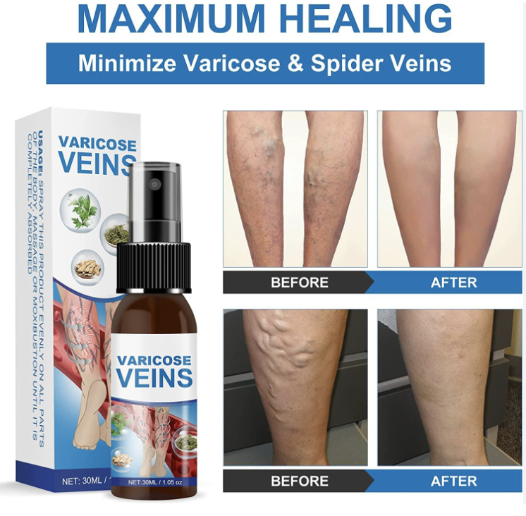 Varicose Vein Spray
