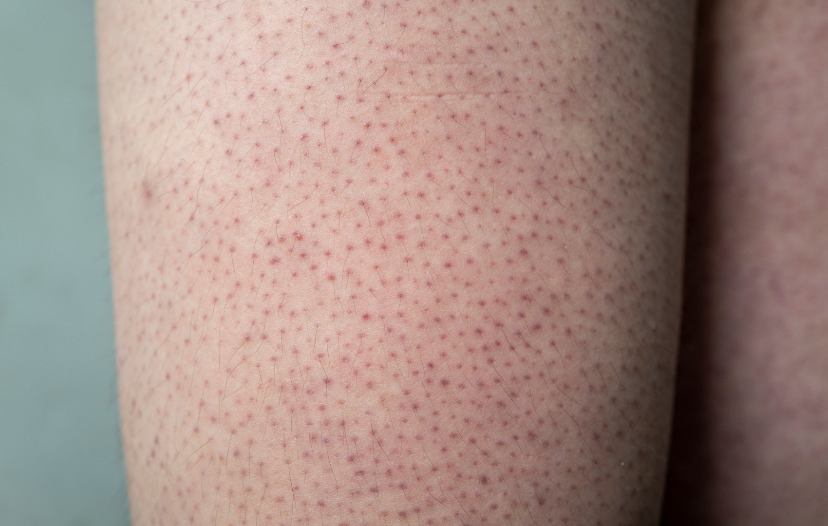 There are many granular protrusions on the arms, keratosis pilaris.