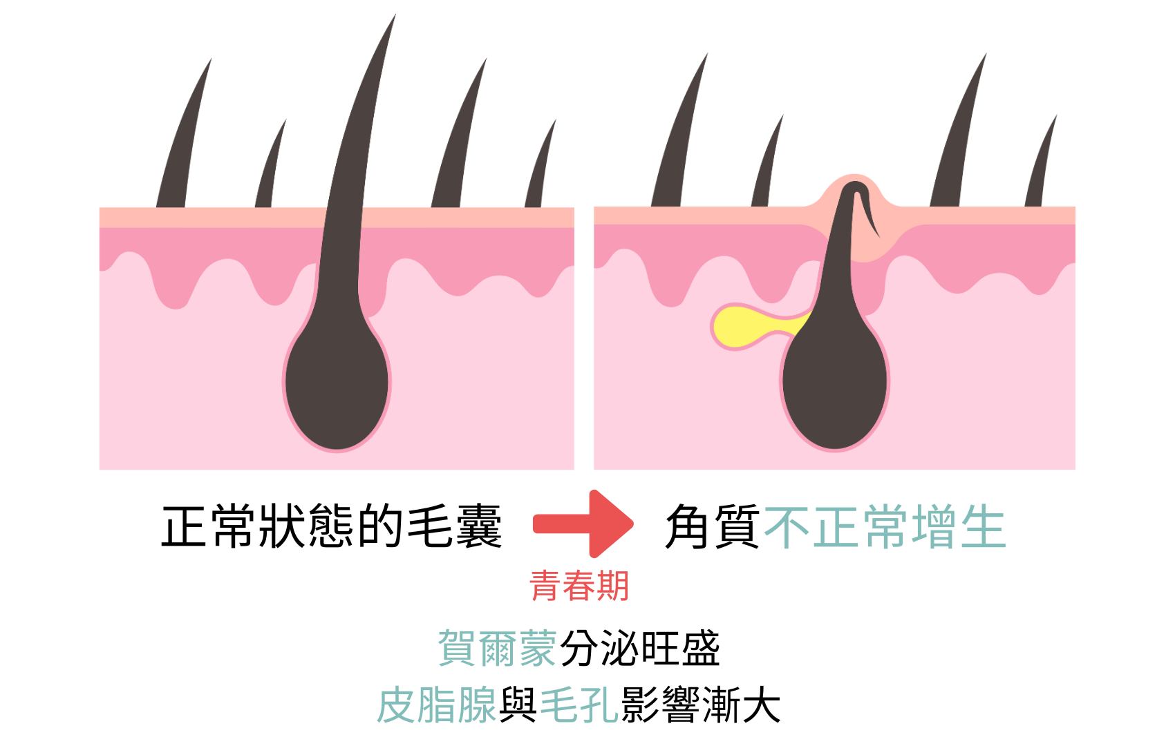 Abnormal proliferation and blockage of hair follicles