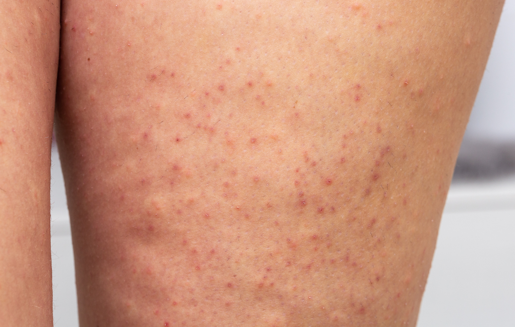 Inflammation of hair follicles