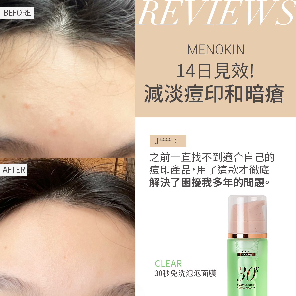 MENOKIN 30秒免洗泡泡面膜CLEAR獲痘痘肌用家推薦,用家表示使用後14日,有效減淡痘印和暗瘡