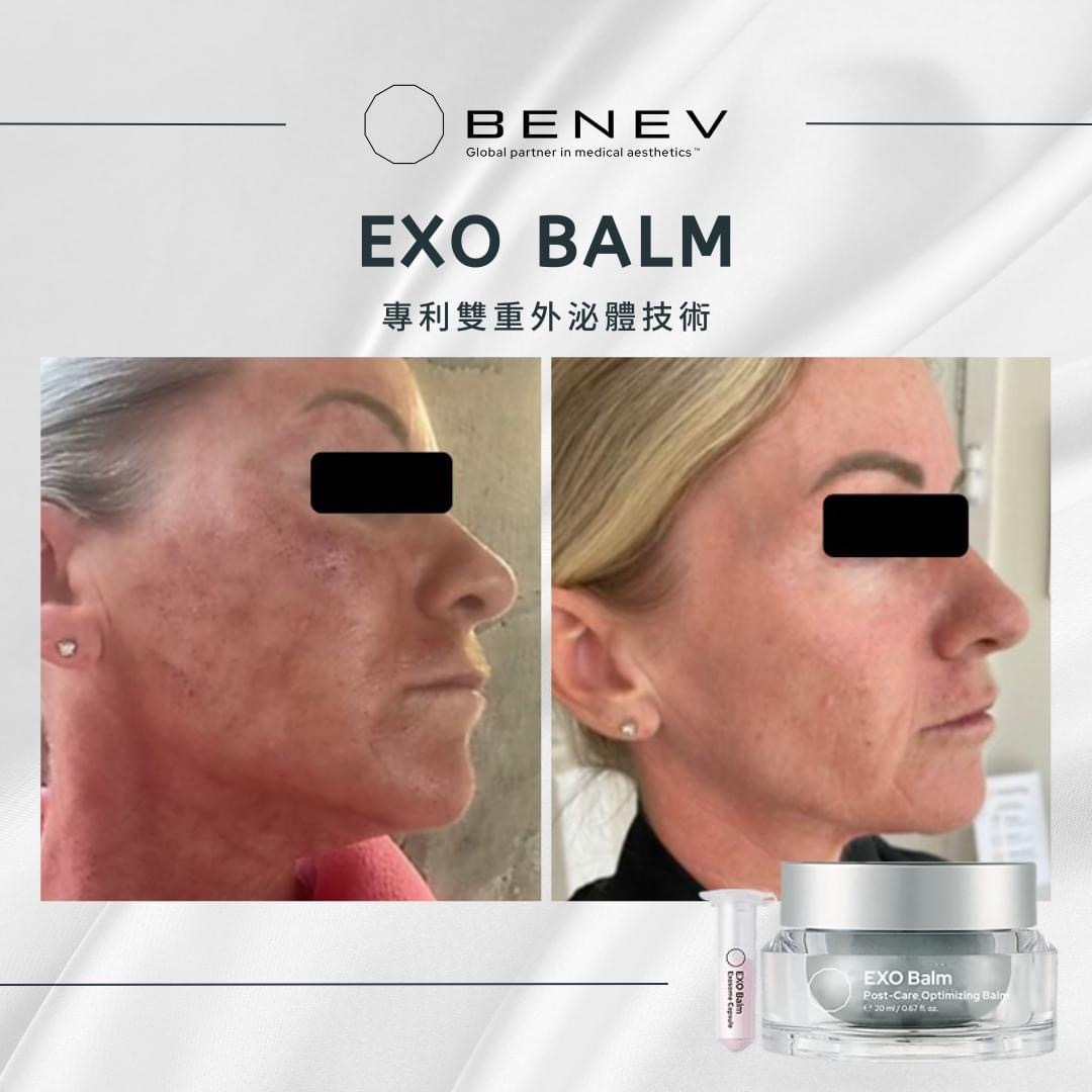 Benev EXO Balm•Exosome•雙重外泌體 外泌體抗敏保濕修復脂質