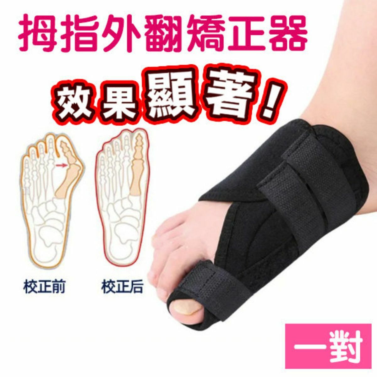 新款【1對】大拇指外翻矯正器 成人護理腳骨 可穿鞋 拇外翻分趾器 [男女適合]