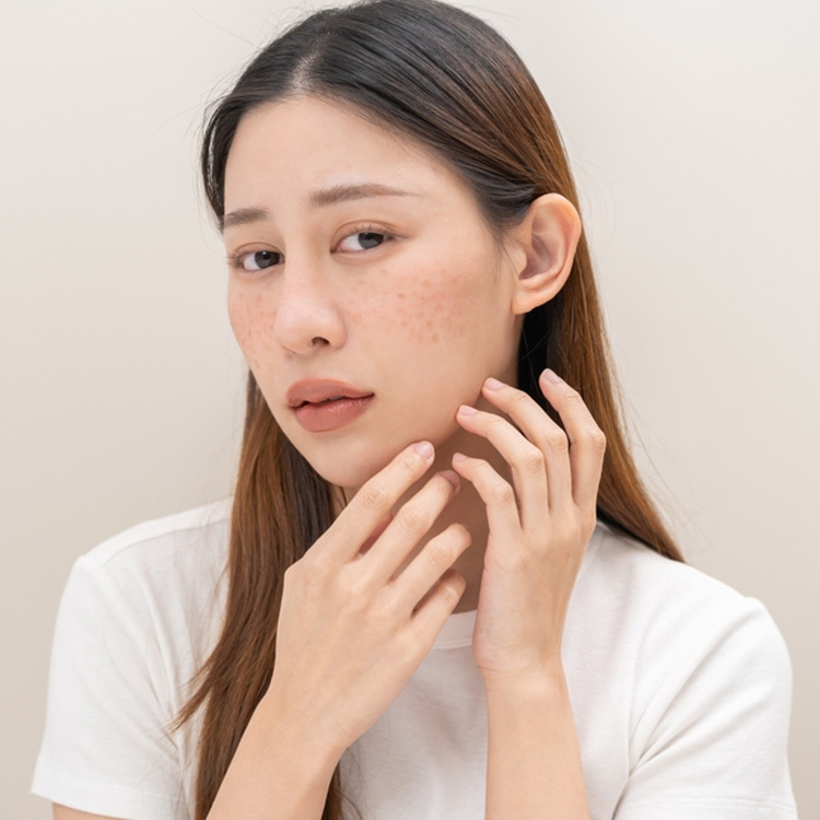 痘痘肌保養與改善怎麼做？4招抗痘方法讓粉刺痘遠離你！