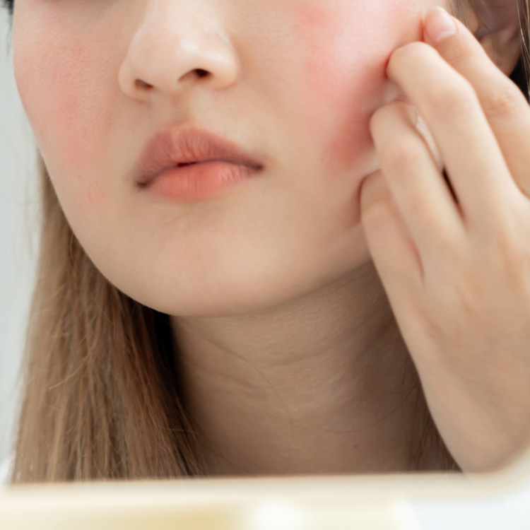 泛紅搔癢是敏感肌膚嗎？敏感肌保養怎麼做才正確？