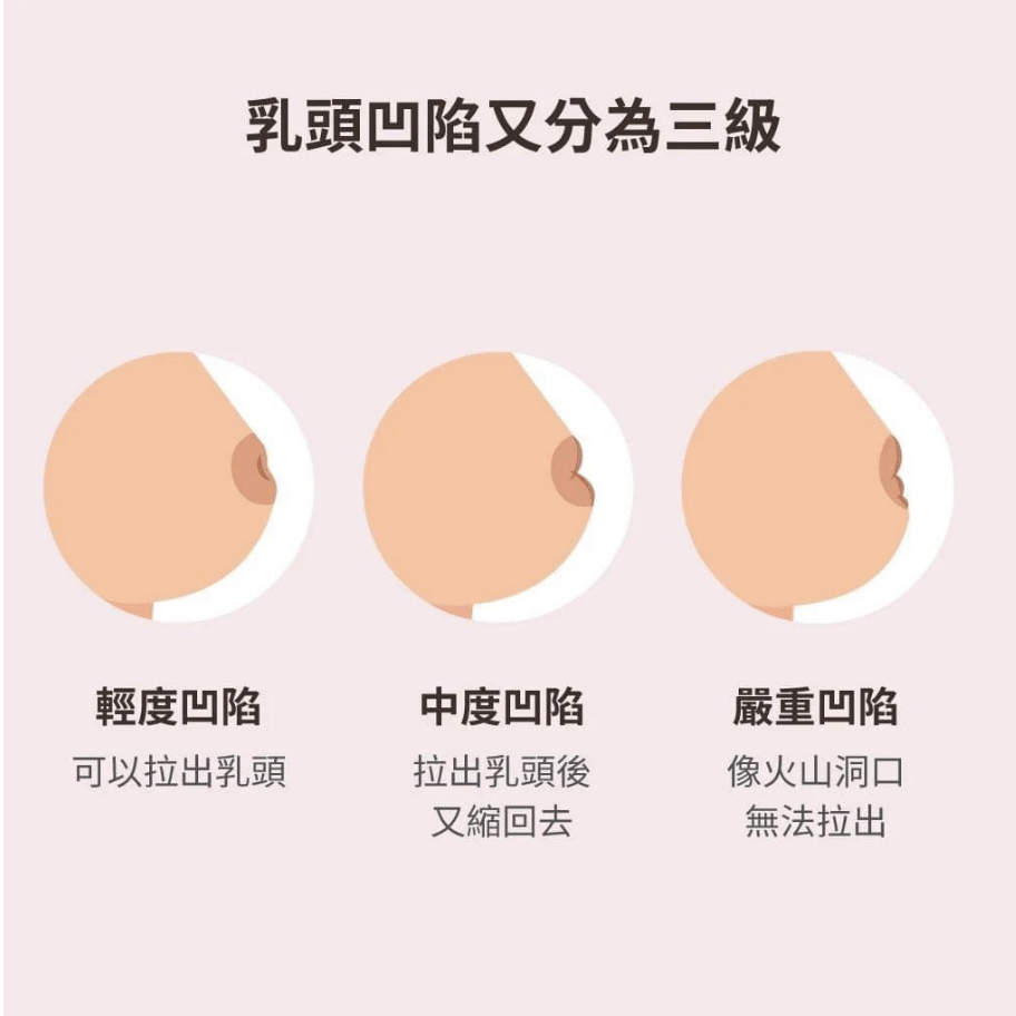 3種程度的乳頭凹陷，分別為：輕微、中度和嚴重凹陷。