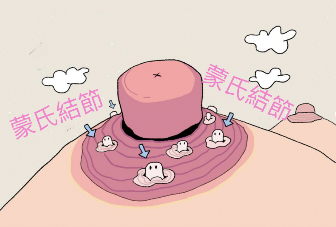 放大的卡通乳頭，旁邊圍繞著一些疙瘩，學名是蒙氏結節。