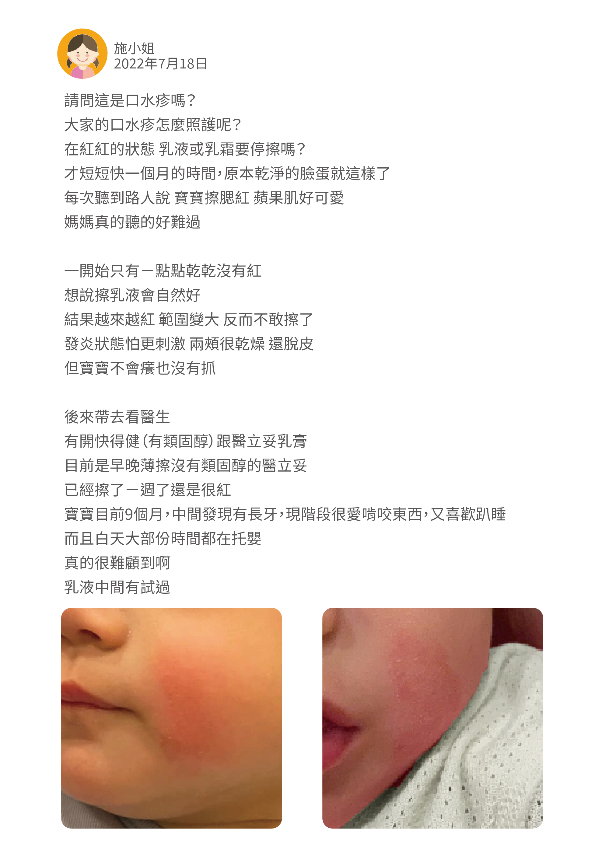 請問這是口水疹嗎? 大家的口水疹怎麼照護呢? 在紅紅的狀態 乳液或乳霜要停擦嗎? 才短短快一個月的時間,原本乾淨的臉蛋就這樣了 每次聽到路人說 寶寶擦腮紅 蘋果肌好可愛 媽媽真的聽的好難過 一開始只有ㄧ點點乾乾沒有紅 想說擦乳液會自然好 結果越來越紅 範圍變大 反而不敢擦了 發炎狀態怕更刺激 兩頰很乾燥 還脫皮 但寶寶不會癢也沒有抓 後來帶去看醫生 有開快得健(有類固醇)跟醫立妥乳膏 目前是早晚薄擦沒有類固醇的醫立妥 已經擦了ㄧ週了還是很紅 寶寶目前9個月,中間發現有長牙,現階段很愛啃咬東西,又喜歡趴睡 而且白天大部份時間都在托嬰 真的很難顧到啊 乳液中間有試過