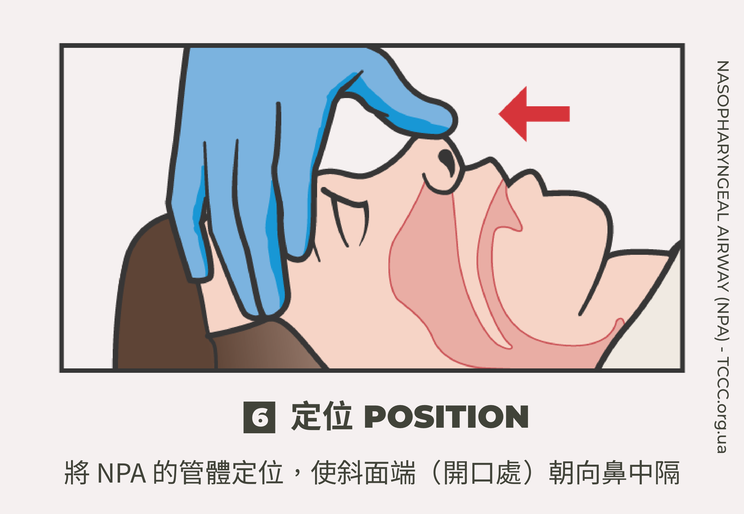 如何正確使用鼻咽氣道管 NPA？TCCC 戰傷知識｜傲骨戰術裝備屋06 定位  將 NPA 的管體定位，使斜面端（開口處）朝向鼻中隔