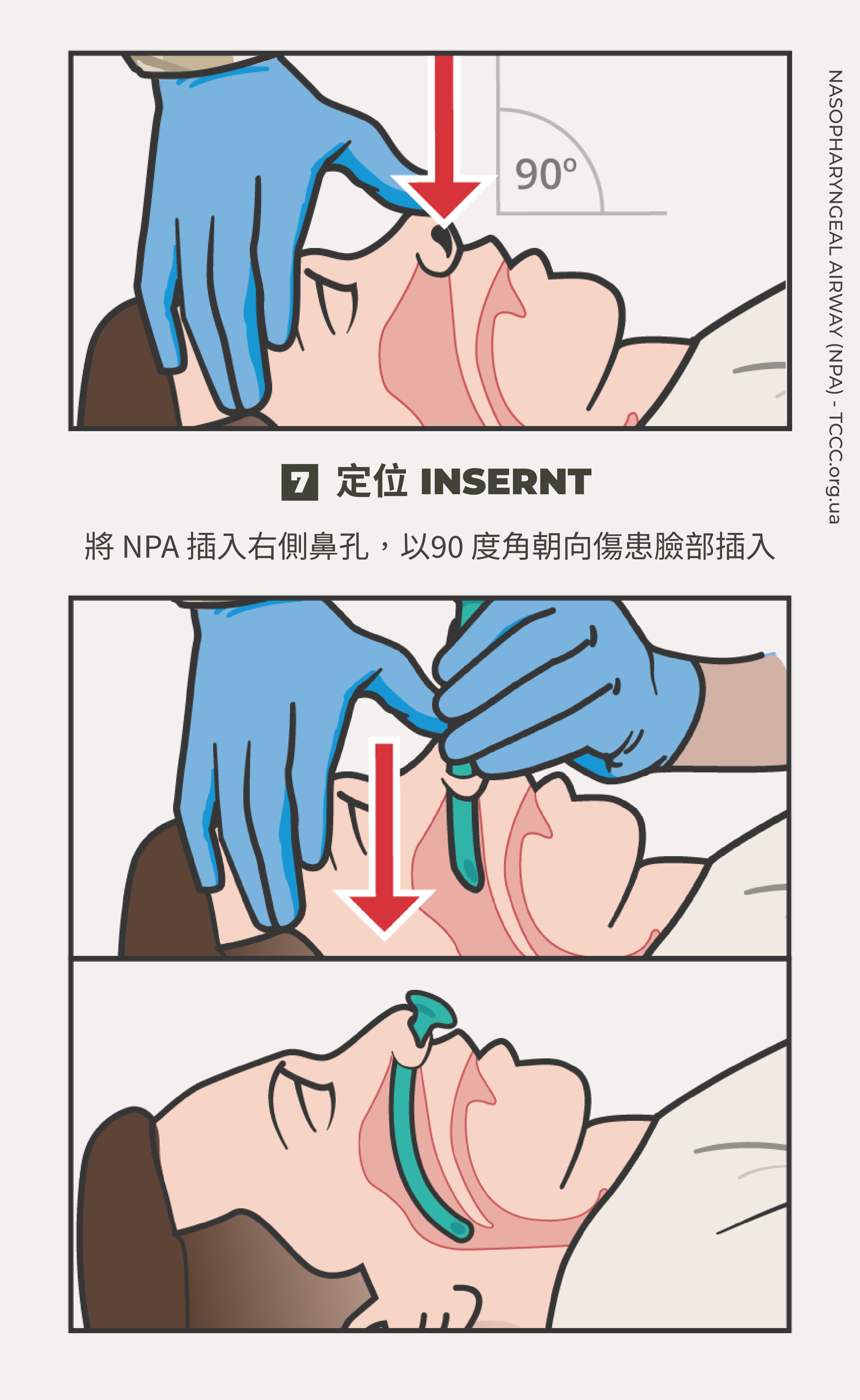 如何正確使用鼻咽氣道管 NPA？TCCC 戰傷知識｜傲骨戰術裝備屋07 插入  將 NPA 插入右側鼻孔，以 90 度角朝向傷患臉部插入  • 保持斜面端朝向鼻腔中線，用流暢的動作推進 NPA  • 直到 NPA 的擋片貼平鼻孔，將管體推進鼻道，不要指向頭頂
