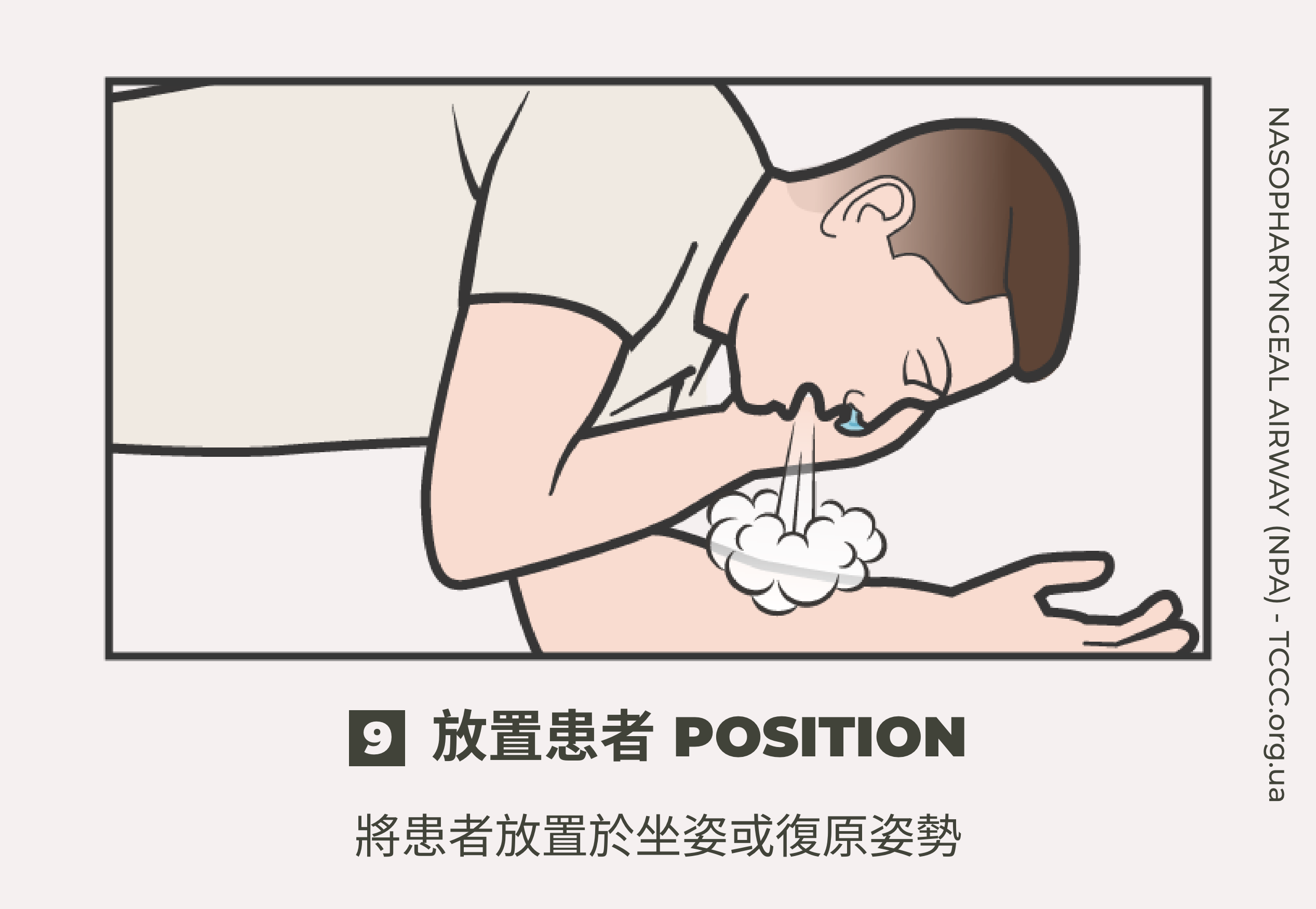 如何正確使用鼻咽氣道管 NPA？TCCC 戰傷知識｜傲骨戰術裝備屋09 放置患者  將患者放置於坐姿或復原姿勢：  • 若患者失去意識，將其放置於復原姿勢，以防止吸入血液、黏液或嘔吐物。