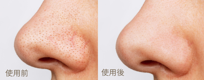 【MUNICHI】親膚磁珠潔面儀 MR.FACE-使用前後