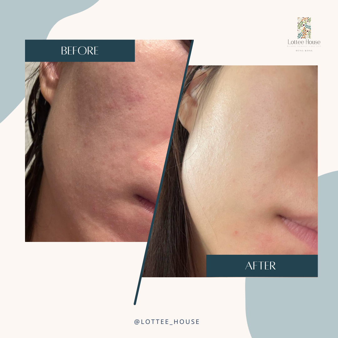 濕疹療膚軟膏 (Step three)