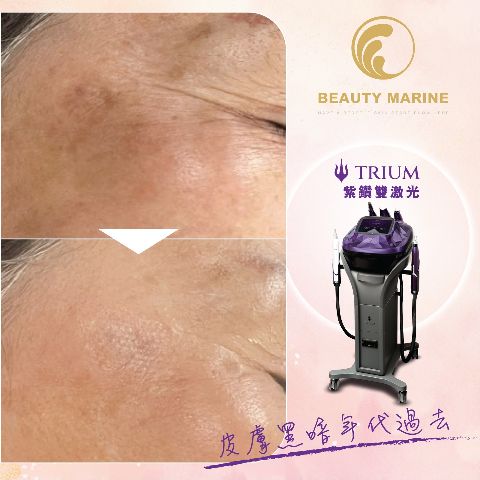 Signature Full Set Facial with 🔱TRIUM🔱首次體驗直播價 $1580