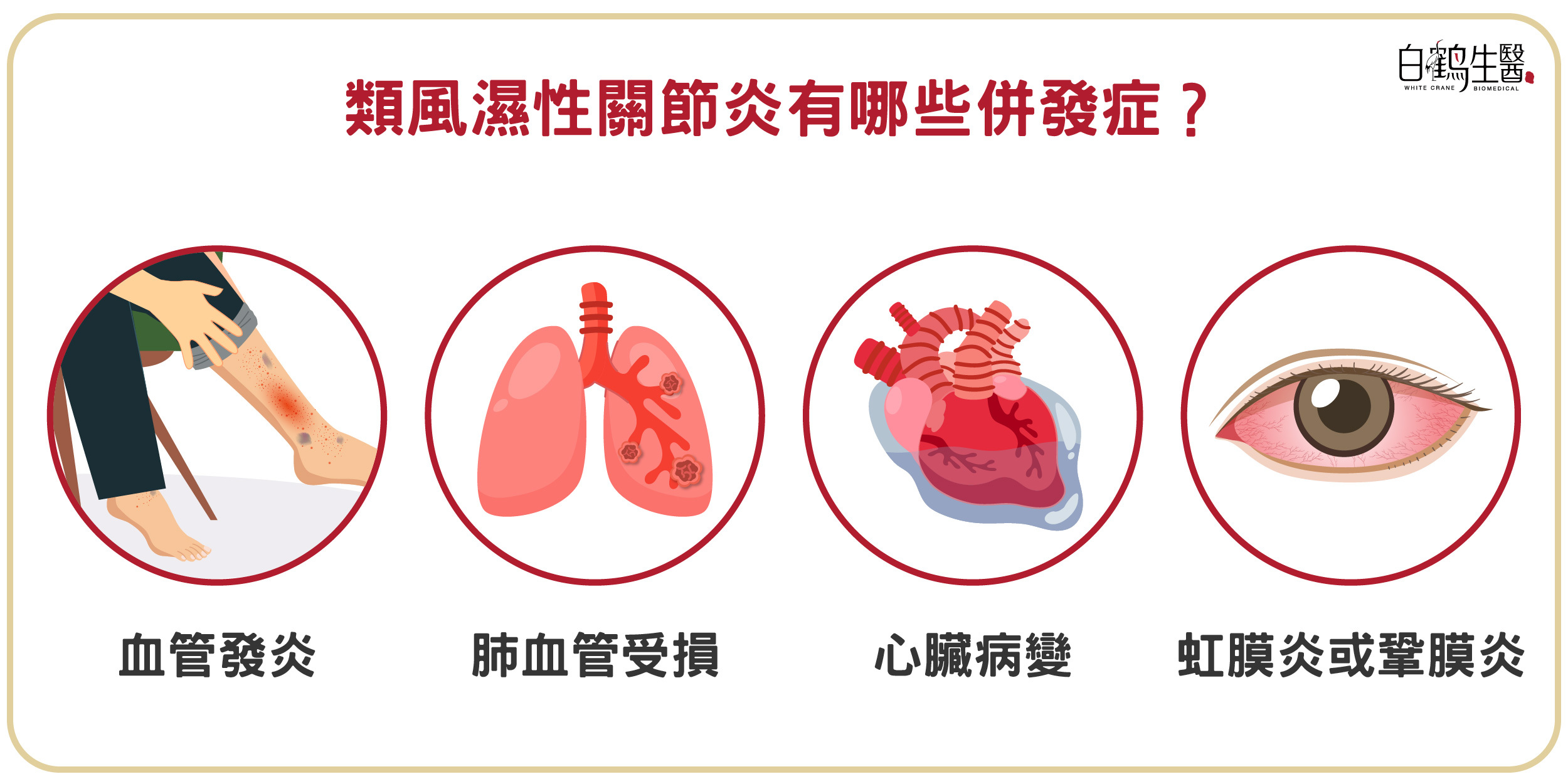 類風溼性關節炎可能併發症包含血管發炎、肺血管受損、心臟病變、虹膜炎