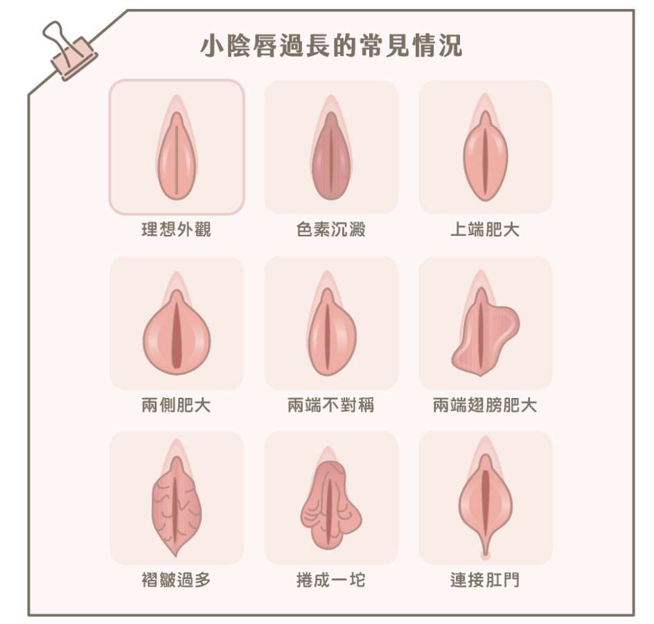9種女生私密處的形狀圖，包括陰唇肥大、兩邊陰唇不對稱等。