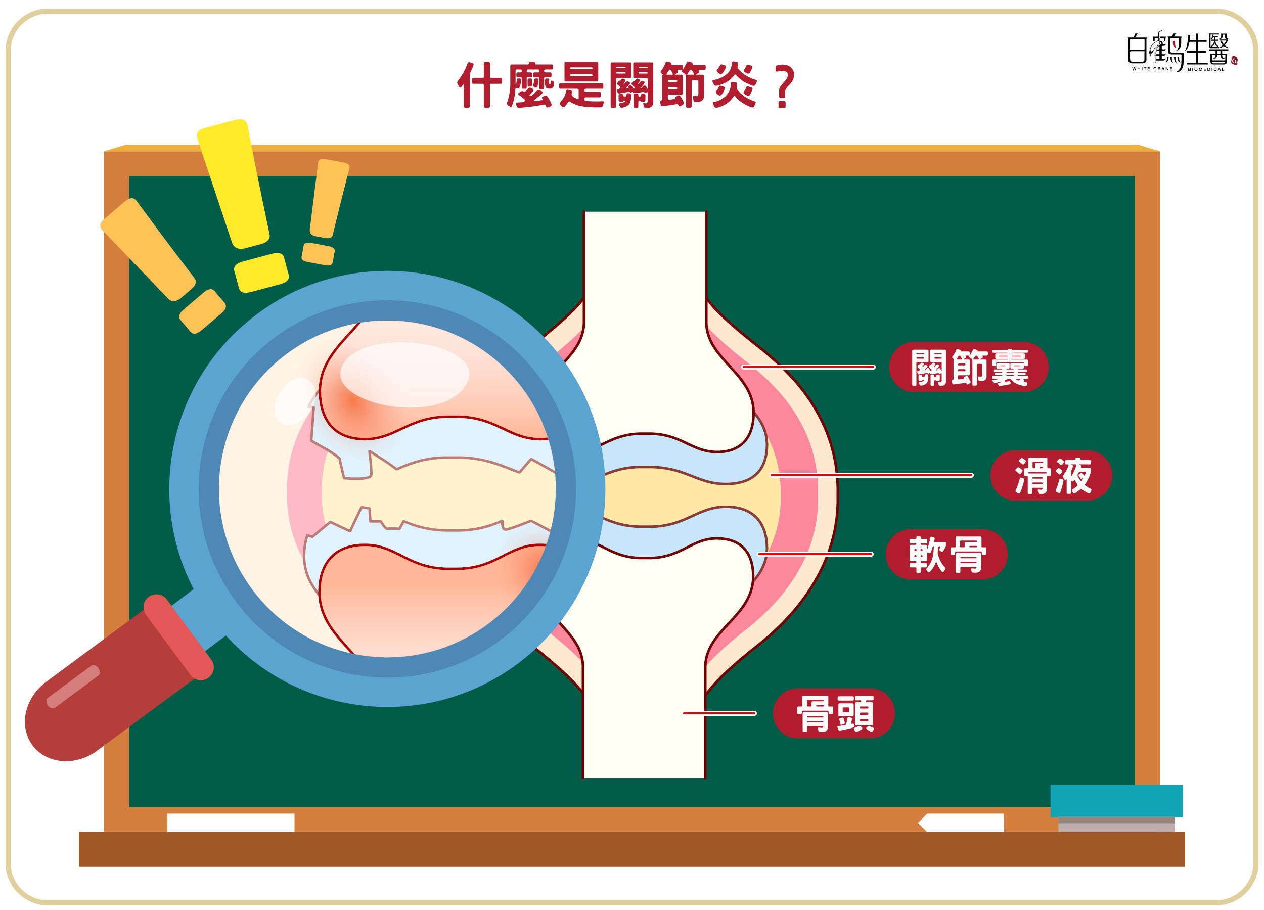 關節炎為當關節的軟骨失去彈性，引起發炎、疼痛等問題