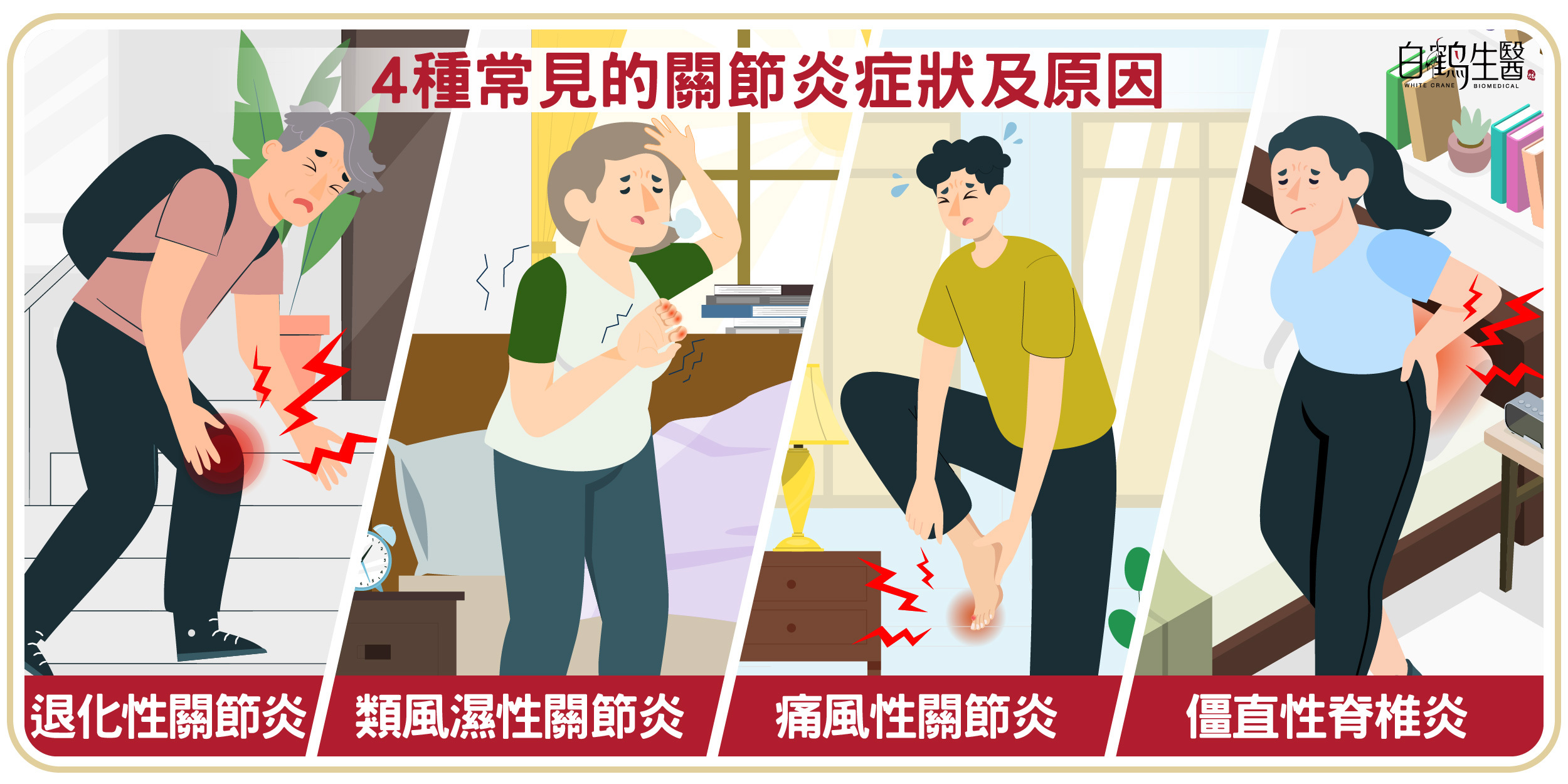 四種常見的關節炎原因為 退化性關節炎、類風濕性關節炎、痛風性關節炎和僵直性脊椎炎。